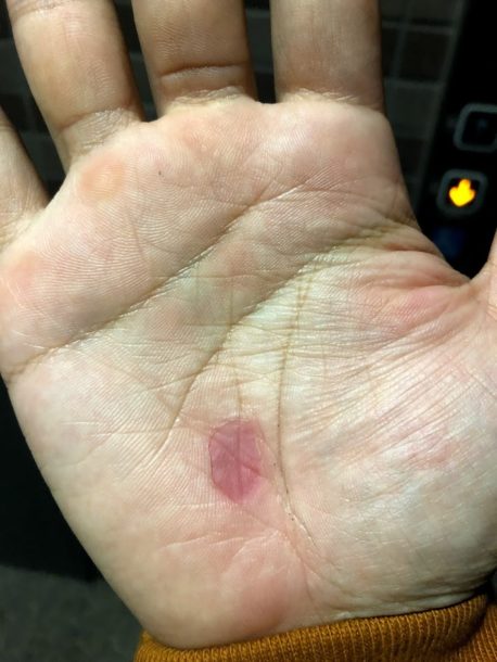 皮がめくれてしまった